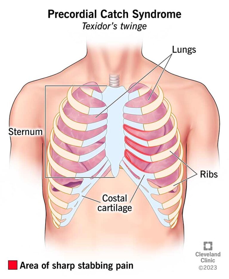 Precordial Catch Syndrome: The Mysterious Chest Pain That Isn’t So Scary!